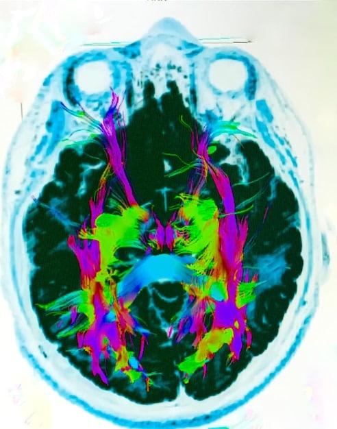 A brain scan highlighting areas associated with reward and pleasure, overlaid with abstract representations of narrative elements like speech bubbles and question marks, symbolizing the psychological engagement of binge-watching.
